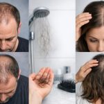האם יש הבדל בין התקרחות גברית ונשית?